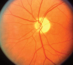 Ischemic Optic Neuropathy