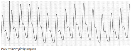 pulse oximeter