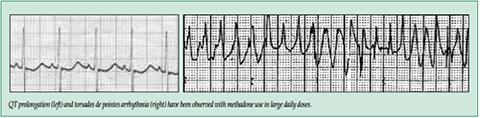 QT prolongation