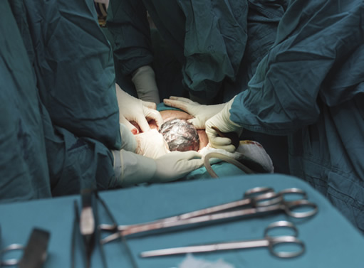 c-section