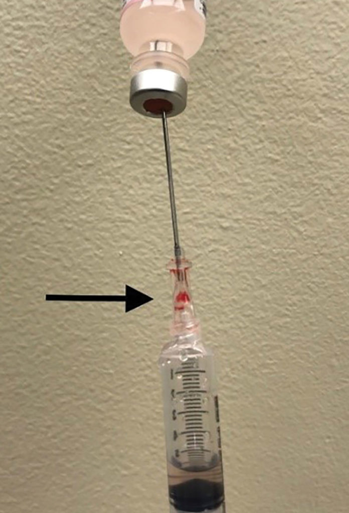 Figure 1. This figure depicts air aspirated into syringe instead of saline from vial due to a defect in the hub of the introducer needle. Arrow points to hub defect location.