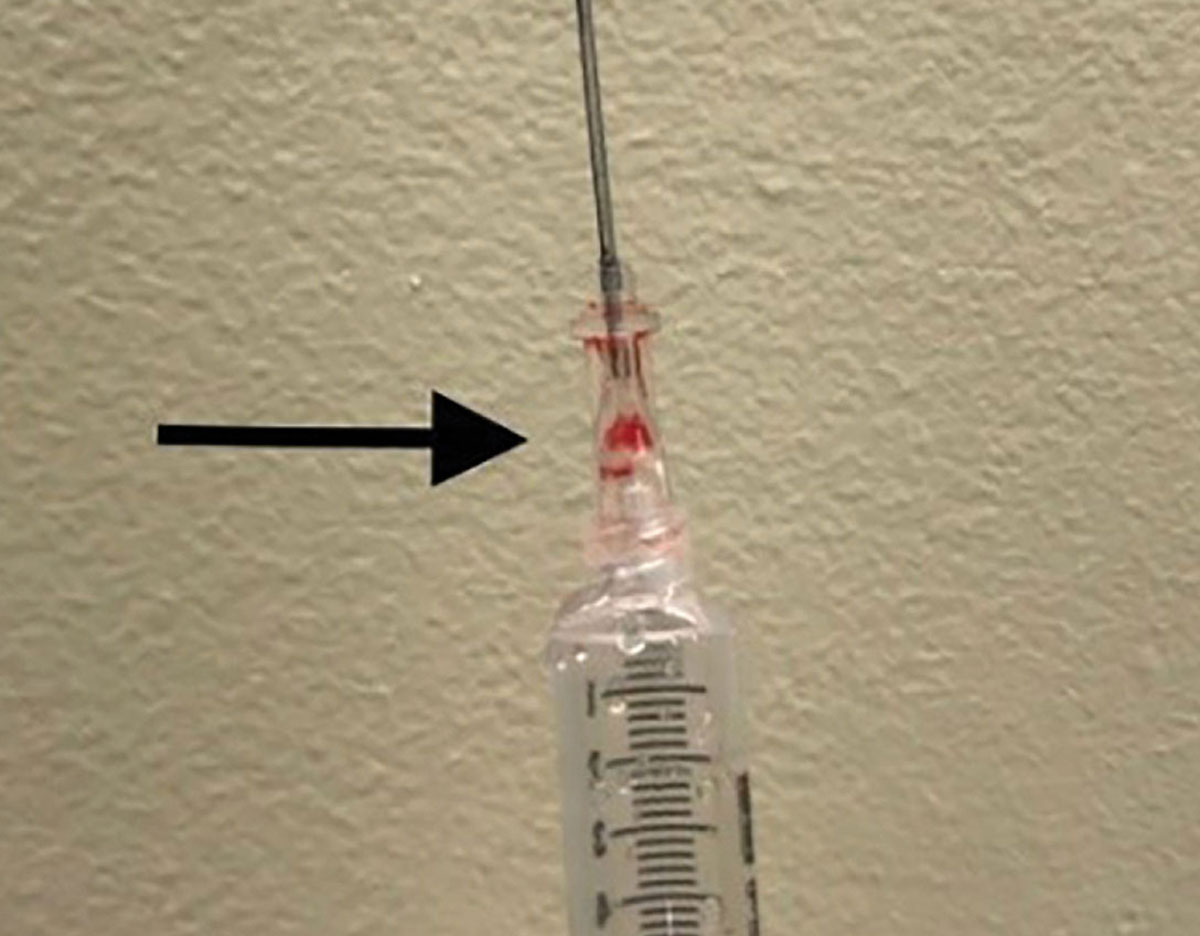 Defective Central Venous Catheter Introducer Needle Anesthesia Patient Safety Foundation