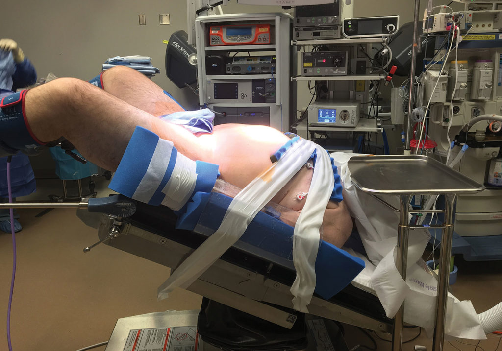 Figure 1. This figure depicts an obese patient in the steep Trendelenburg position being prepared for robotic surgery.