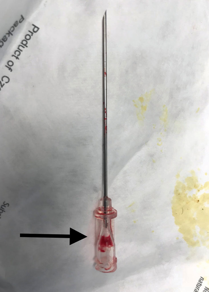 Figure 2. This figure depicts the 18 gauge introducer needle with a defect in the hub resulting in an inability to aspirate fluid. Arrow points to hub defect location.