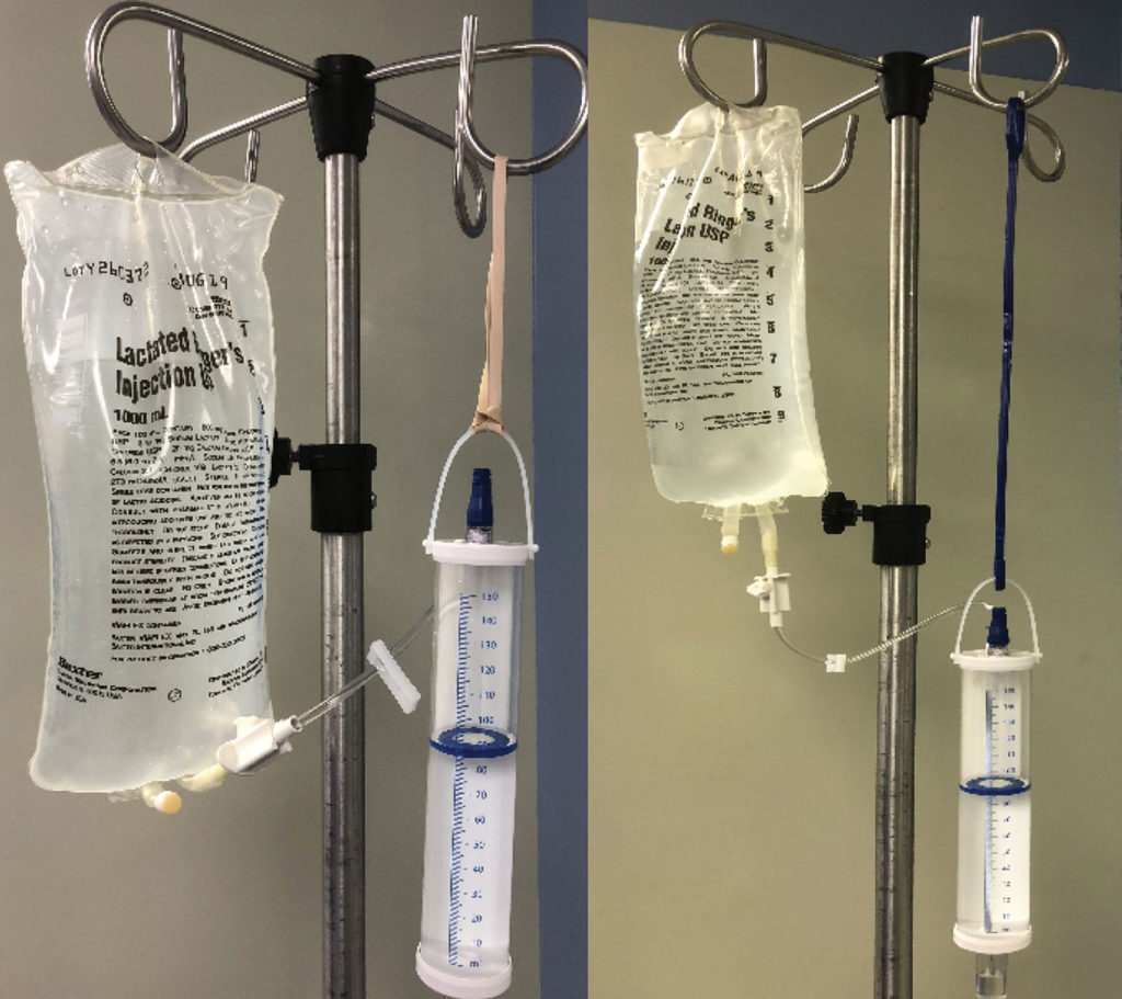 Burette Malpositioned Shut Off Valve Could Lead to Venous Air Embolism