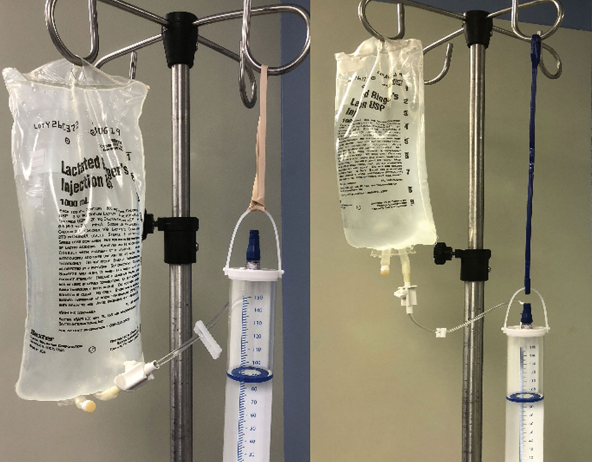 Burette Malpositioned Shut Off Valve Could Lead to Venous Air Embolism