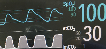 オピオイド誘発性呼吸抑制のモニタリング Anesthesia Patient Safety Foundation