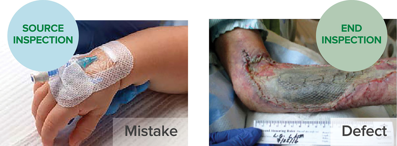 Figure 2. Examples of a Mistake (where a placed intravenous line is infiltrated) vs. a Defect (where the unrecognized infiltrated intravenous line resulted in tissue necrosis of the arm).