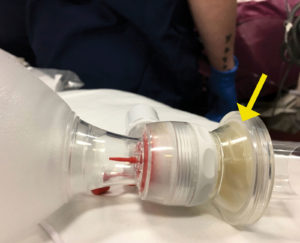 Figure 1 : Insufflateur Ambu® avec filtre obturé. La flèche jaune indique le filtre.