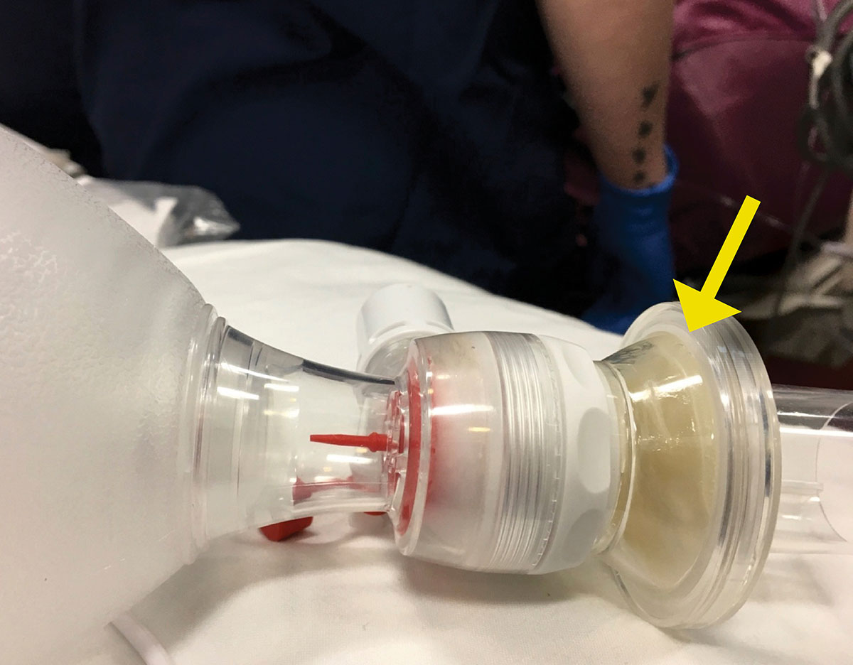 PEA Arrest During Transport of a Ventilated Patient Due to a Clogged ...