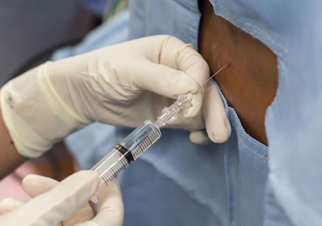 PRO et CON utiliser une péridurale de travail pour une césarienne