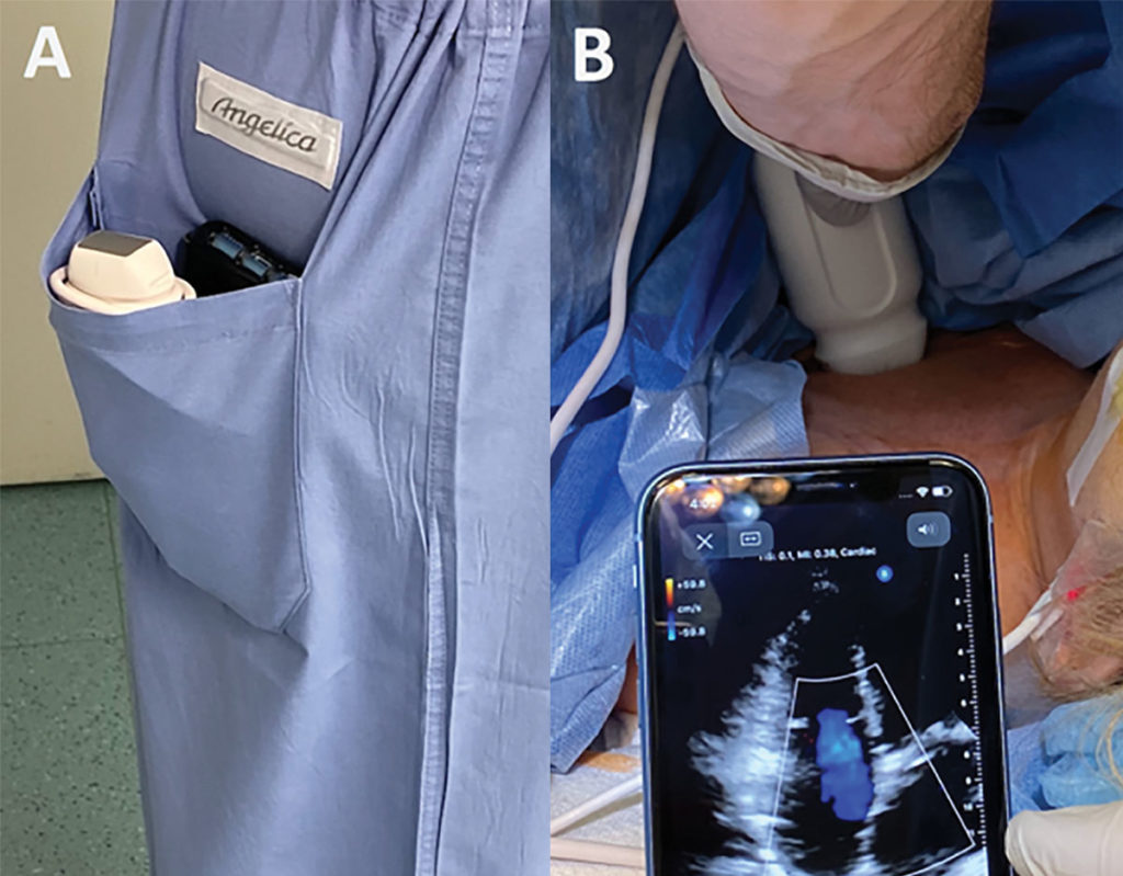 Portable Point of Care Ultrasound (PPOCUS) An Emerging Technology for