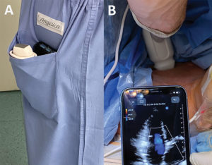 Figure 1: Extreme portability afforded by portable ultrasound devices (Panel A) and use of PPOCUS in perioperative settings such as in the operating room (Panel B).