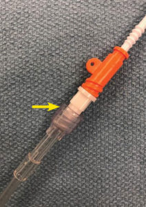 Figure 2: The yellow arrow shows the connection between the RIC dilator hub and infusion tubing.