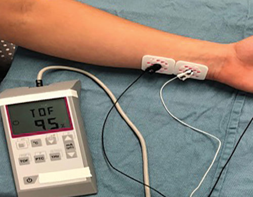 Quantitative Neuromuscular Blockade Monitor