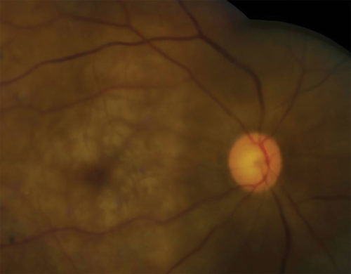 Perioperative Vision Loss