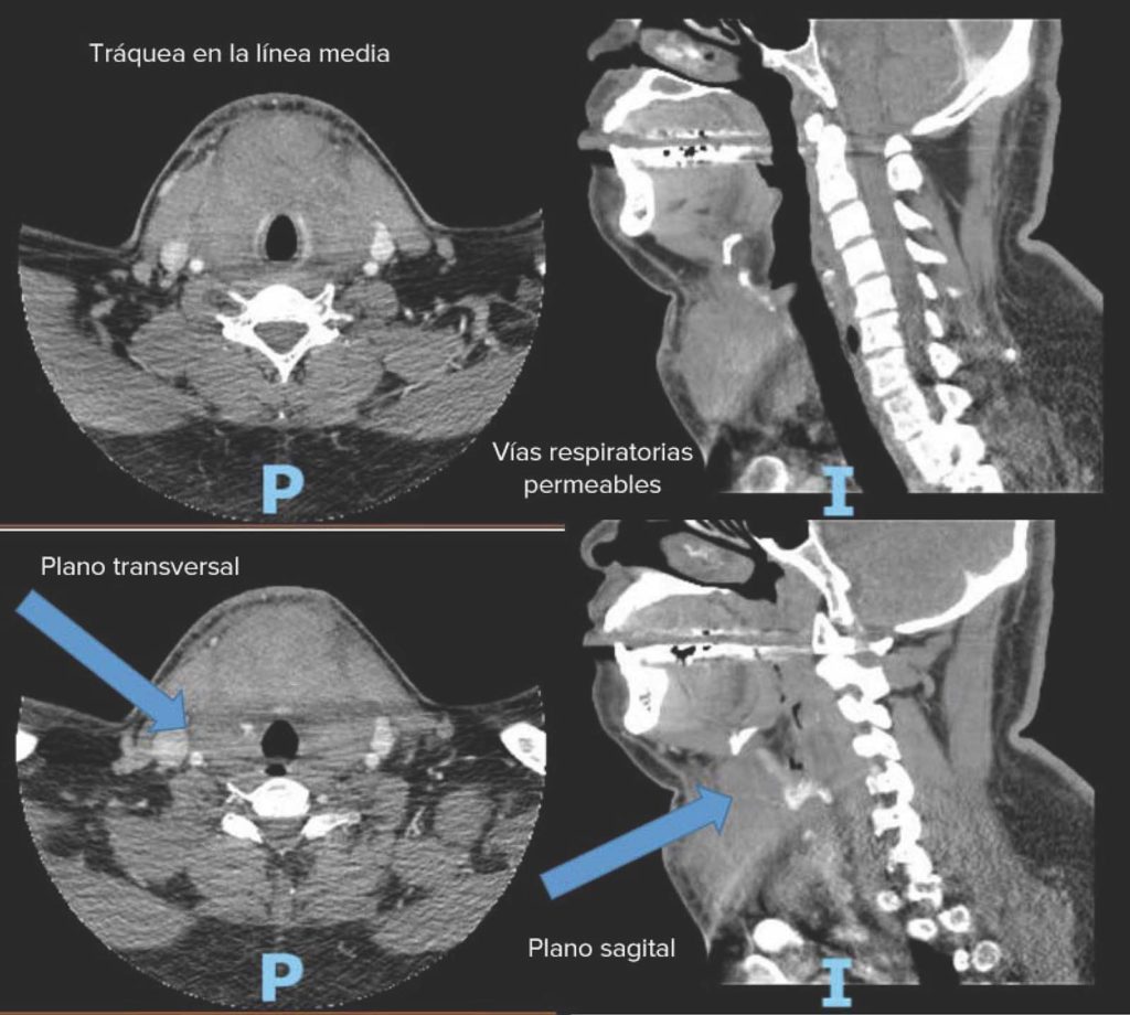 Figura 1: Las flechas indican la extravasación activa del contraste desde la arteria tiroidea superior hasta la derecha del cartílago cricoides, y la formación del hematoma en la zona anterior a la tráquea. (Las letras P e I no son relevantes para esta ilustración).