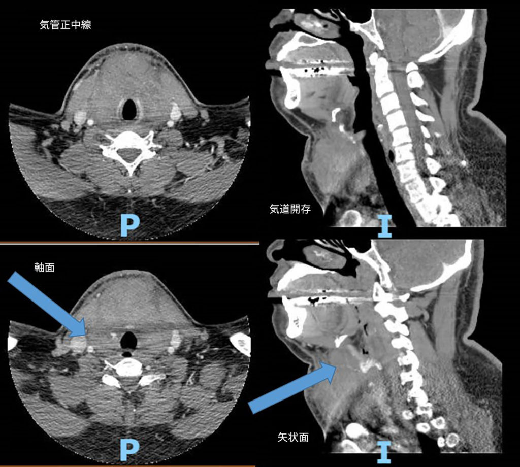 図 1：矢印は、上甲状腺動脈から輪状軟骨の右側へのアクティブな造影剤漏出を示し、気管の前方に血腫が形成されている。（PとIはこの図とは無関係である）