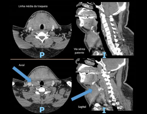 Hematoma cervical (HC) no pós-operatório: a intervenção rápida é vital