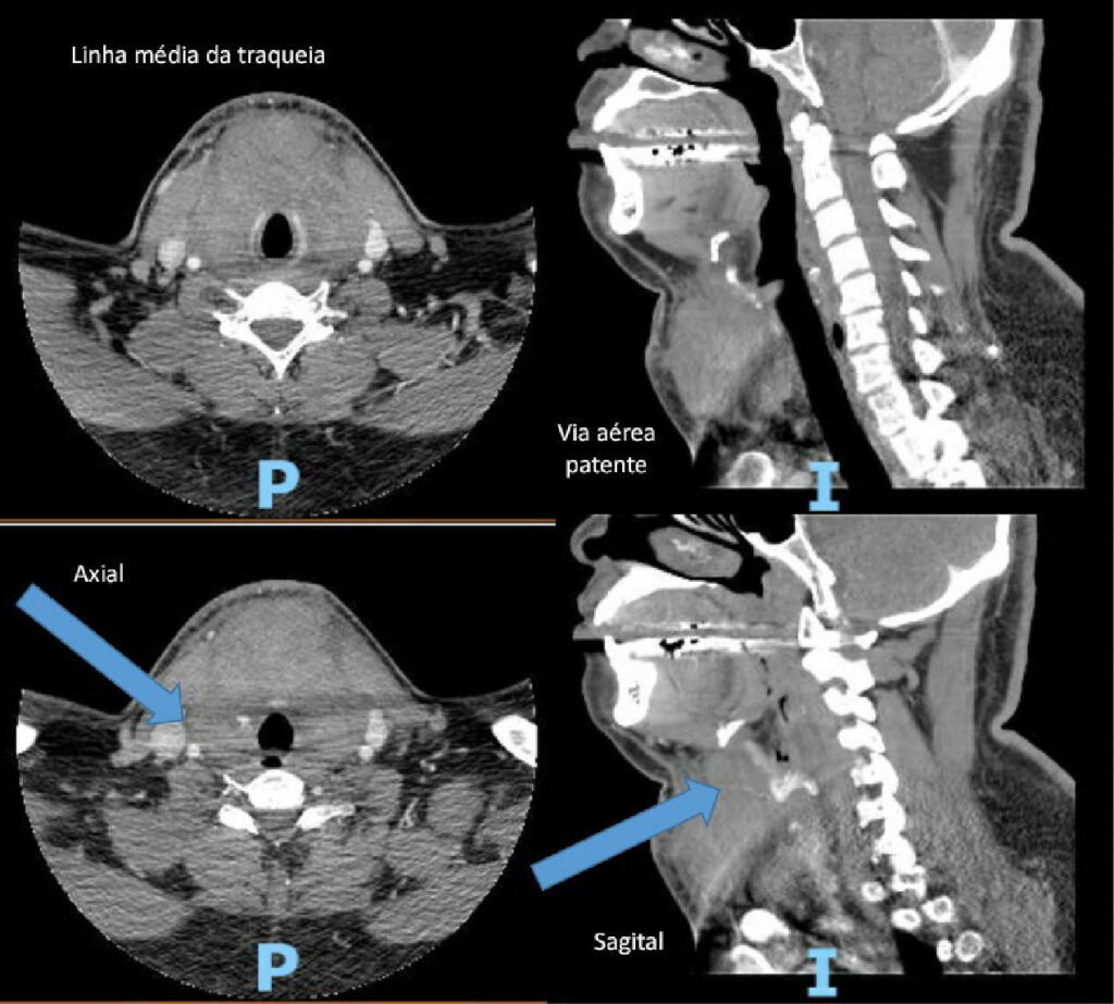 Figura 1: As setas indicam extravasamento ativo de contraste da artéria tireoide superior à direita da cartilagem cricoide com formação de hematoma anterior à traqueia. (P e I não são relevantes para essa ilustração.)