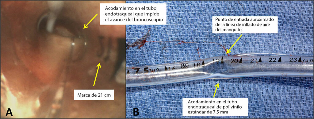 Figura A: Evaluación broncoscópica que demuestra la obstrucción supraglótica del tubo endotraqueal de polivinilo cerca de la marca de 19 centímetros.<br /> Figura B: Fotografía del tubo endotraqueal de polivinilo de 7,5 centímetros del paciente después de la extubación con un estrechamiento luminal de ángulo agudo evidente en la marca de 19 centímetros.