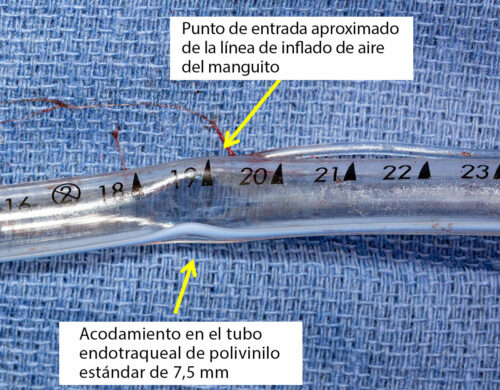 Evaluación broncoscópica que demuestra la obstrucción supraglótica del tubo endotraqueal de polivinilo cerca de la marca de 19 centímetros.