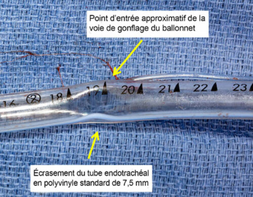 Photographie de la sonde endotrachéale en polyvinyle de 7,5 centimètres du patient après l’extubation avec un rétrécissement luminal à angle aigu visible au repère des 19 centimètres.