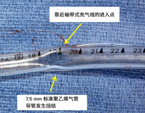 图A：支气管镜评价显示聚乙烯气管导管在 19 厘米标尺附近发生了声门上堵塞。 图B：患者的 7.5 厘米聚乙烯气管导管拔管后的照片，显示在 19 厘米标尺处明显存在锐角管腔变窄。