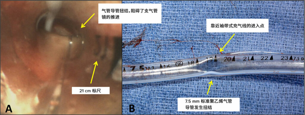 图A：支气管镜评价显示聚乙烯气管导管在 19 厘米标尺附近发生了声门上堵塞。<br /> 图B：患者的 7.5 厘米聚乙烯气管导管拔管后的照片，显示在 19 厘米标尺处明显存在锐角管腔变窄。