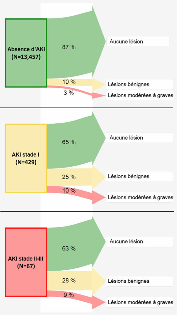 Figure 6 : Résultats rénaux 1 à 2 ans après la chirurgie, en fonction du stade de l’insuffisance rénale aiguë postopératoire. La largeur des flèches représente le pourcentage de patients de chaque groupe étudié souffrant de chaque stade d’insuffisance rénale durable.<sup>37</sup> Un quart des patients souffrant d’insuffisance rénale postopératoire de stade I (hausse de la créatine de ≥ 0,3 mg/dl ou 1,5–1,9 fois le niveau de référence) présentait encore une légère insuffisance 1 à 2 ans plus tard, et 10 % présentaient un stade d’insuffisance encore plus élevé. Un bon tiers des patients avec une insuffisance rénale de stade I présentait donc une insuffisance rénale 1 à 2 ans après la chirurgie. Par conséquent, les patients présentant une insuffisance postopératoire de stade I avaient un rapport des cotes (95 % IC) de 2,3 (1,8, 2,9) de souffrir d’insuffisance rénale durable chronique par rapport aux patients sans insuffisance rénale postopératoire. Nous avons donc conclu que chez les adultes se rétablissant d’une chirurgie non cardiaque, même une légère augmentation postopératoire de la créatinine plasmatique, correspondant à une insuffisance rénale de stade I, est associée à un résultat rénal plus grave 1 à 2 ans après la chirurgie, devant par conséquent être considéré comme un résultat périopératoire cliniquement important.<br /> <br /> Reproduit et modifié avec l’aimable autorisation des auteurs. Turan A, Cohen B, Adegboye J, Makarova N, Liu L, Mascha EJ, Qiu Y, Irefin S, Wakefield BJ, Ruetzler K, Sessler DI. Mild acute kidney injury after noncardiac surgery is associated with long-term renal dysfunction: a retrospective cohort study. <em>Anesthesiology</em>. 2020;132:1053–1061.