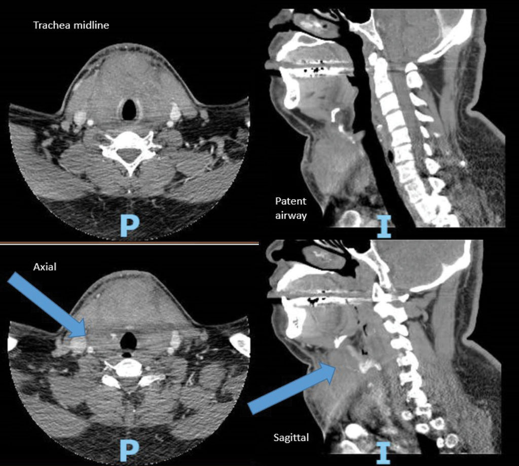 Figure 1: Arrows indicate active contrast extravasation from superior thyroid artery to the right of cricoid cartilage with hematoma formation anterior to the trachea. (P and I are not relevant to this illustration.)