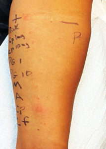 Figure 1 : Illustration d’un prick-test et de tests cutanés intradermiques positifs à la céfazoline (Cp) suite à deux épisodes distincts d’anaphylaxie provisoirement associée à la céfazoline deux mois auparavant. Le prick-test de contrôle à l’histamine (H) est positif. Le prick-test et les tests intradermiques de contrôle à une solution saline sont négatifs. Les tests cutanés intradermiques à d’autres agents réactifs comprenant l’ampicilline 25 mg/l, la benzylpénicilline 1000 et 10 000 IU/ml, un mélange de déterminants mineurs (MDM) et un déterminant majeur (Pre-pen) étaient négatifs.