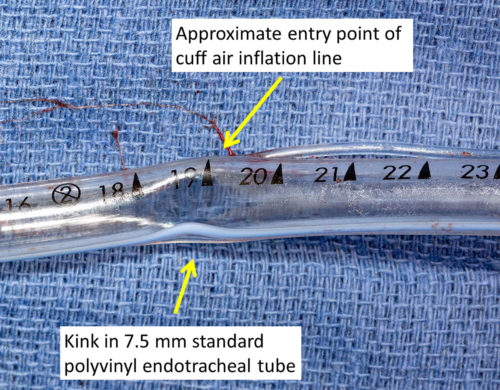 Kink in Endotracheal Tube