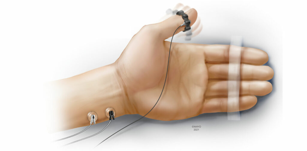 Figure 1 : L’accéléromyographie