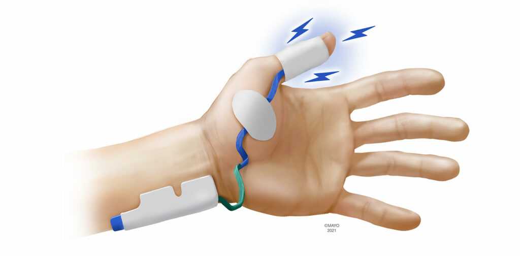 Figura 3: Eletromiografia<br /> <br />Reproduzido e modificado com permissão.