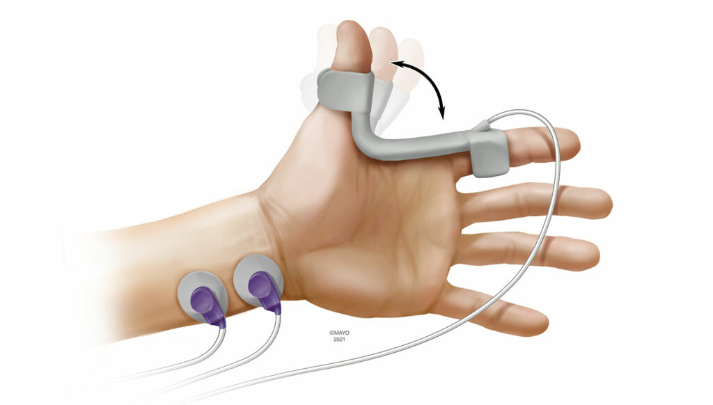 Figure 2 : La kinémyographie