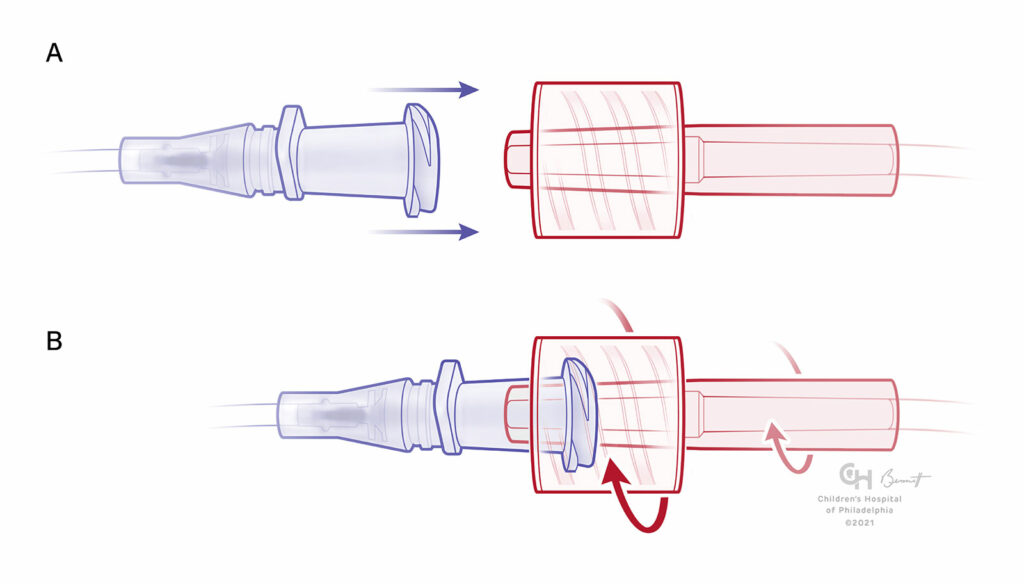 Figure 2 : A) Luer-Lock mâle avec un manchon fixe recevant une pièce femelle qui n’est pas encore enclenchée. B) Pièce mâle avec un manchon fixe « verrouillée » à sa place. Remarque : un raccord à manchon fixe peut faire subir une force de rotation (couple) à une tubulure fixée aux raccords.