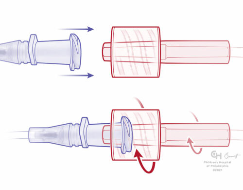 Male Luer-Lock with fixed-skirt and receiving female component unengaged