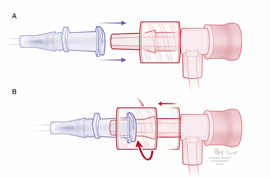 Figures 3 : A) Luer-Lock mâle avec un manchon rotatif recevant une pièce femelle qui n’est pas encore enclenchée. B) Pièce mâle avec un manchon rotatif enclenché. Remarque : le manchon rotatif permet d’engager le cône Luer en premier, puis de le sécuriser au moyen du manchon, afin d’éviter une force de rotation sur la tubulaire raccordée. Remarque : le manchon rotatif permet d’engager le cône Luer en premier, puis de le sécuriser au moyen du manchon, afin d’éviter une force de rotation sur la tubulaire raccordée.