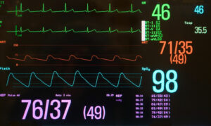 Perioperative Hypotension