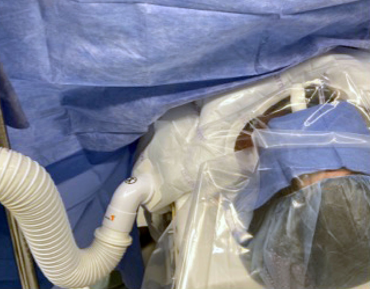 Thermal Injury After Use of a Convective Warming System Anesthesia