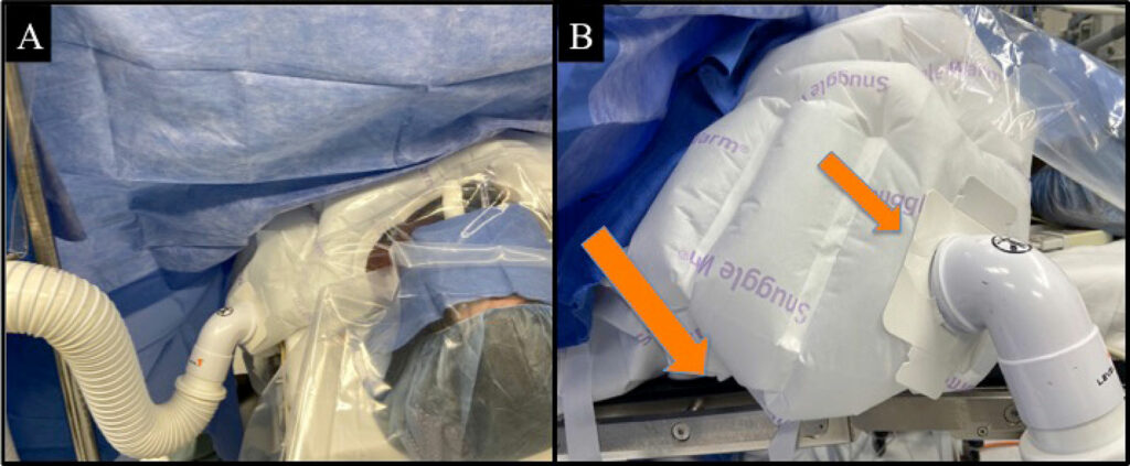 Figure 1: Panel A demonstrates the configuration of the warming device in these cases, with the warming hose connected to the upper body warming blanket connection port near the left shoulder. The warming hose is suspended with a retaining clip. Panel B orange arrows highlight the “arms” of the warming blanket tucked into the crease between the operating room table, and the connection port near the patient’s left shoulder.