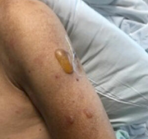 Figure 3: Blisters noted on post-operative day one (patient consent obtained for use of this image).