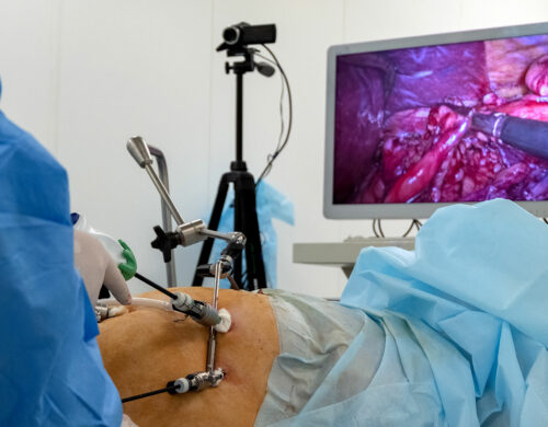 Laparoscopic Surgery