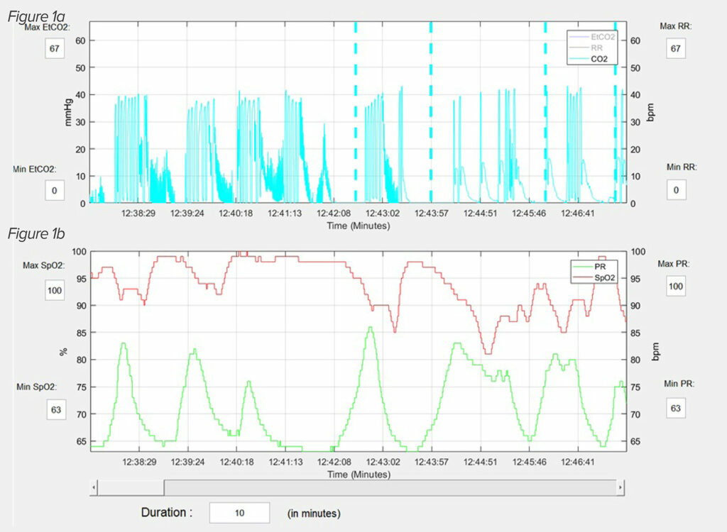 Figure 1: An actual capnography (1a) and pulse oximetry (1b) reading from PRODIGY, illustrates the typical OIRD breathing pattern.20 This patient is having repetitive apnea and partial apnea episodes interceded with normal breathing patterns. The periods of hypoxemia develop during the apnea episodes and the oxygen saturation normalizes when normal breathing resumes. Reprinted and modified with permission from Anesthesia & Analgesia and Wolters Kluwer Health, Inc.