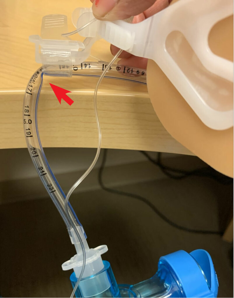 Figure 1a: Endotracheal tubes secured with Hollister (Hollister Inc., Libertyville, IL) endotracheal tube fastener, with kink when attached to Ambu bag (Ambu Inc., Columbia, MD) without offloading the weight of the circuit/ventilation system.