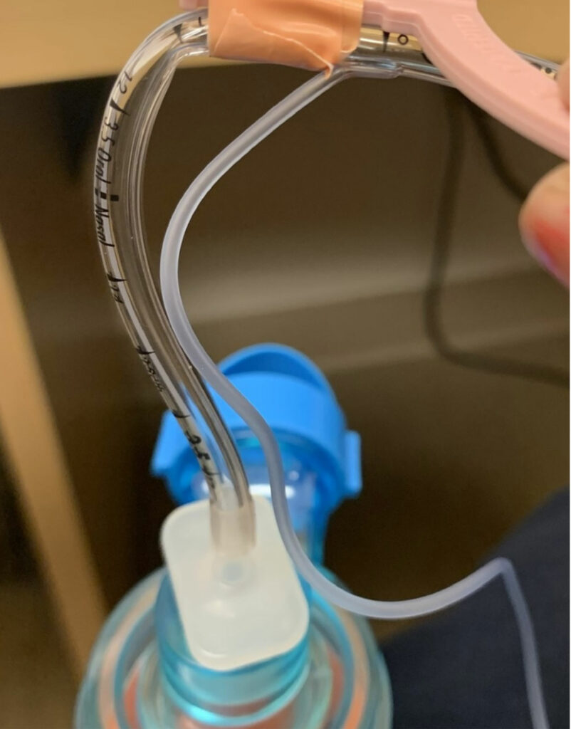 Figure 1b: Endotracheal tubes secured with NeoBar ET tube (NeoTech Products LLC, Valencia, CA) with kink when attached to ambu bag (Ambu Inc., Columbia, MD) without offloading the weight of the circuit/ventilation system.