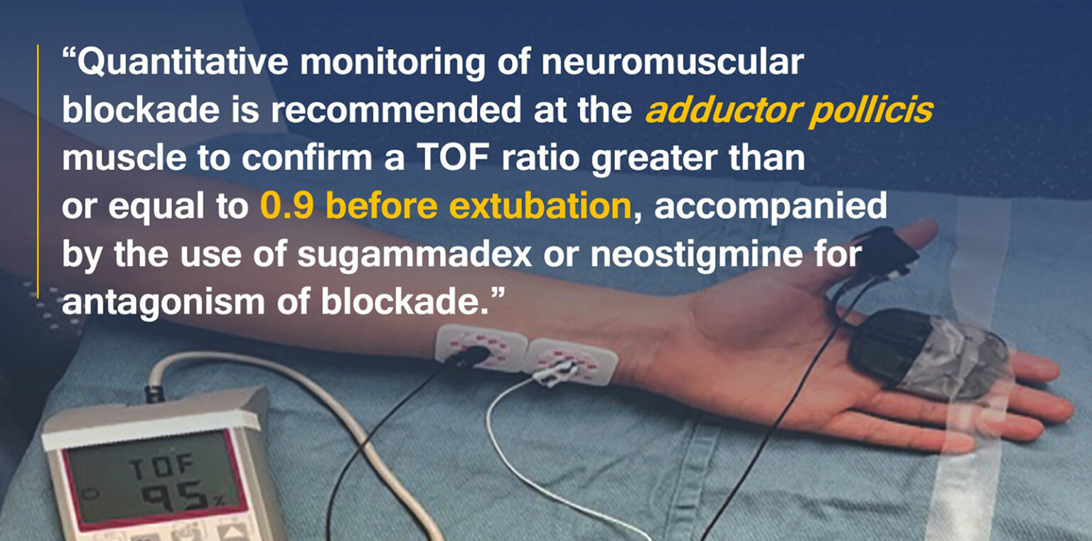 New Practice Guidelines for Neuromuscular Blockade Anesthesia Patient Safety Foundation