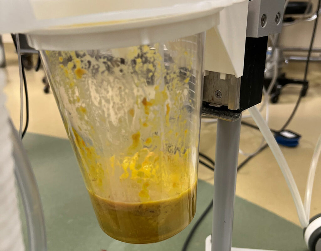 Figure 2 : Depicts large volume emesis of particulate matter in a patient on a GLP-1 agonist that was consistent with what the patient reported eating several days prior to surgery.