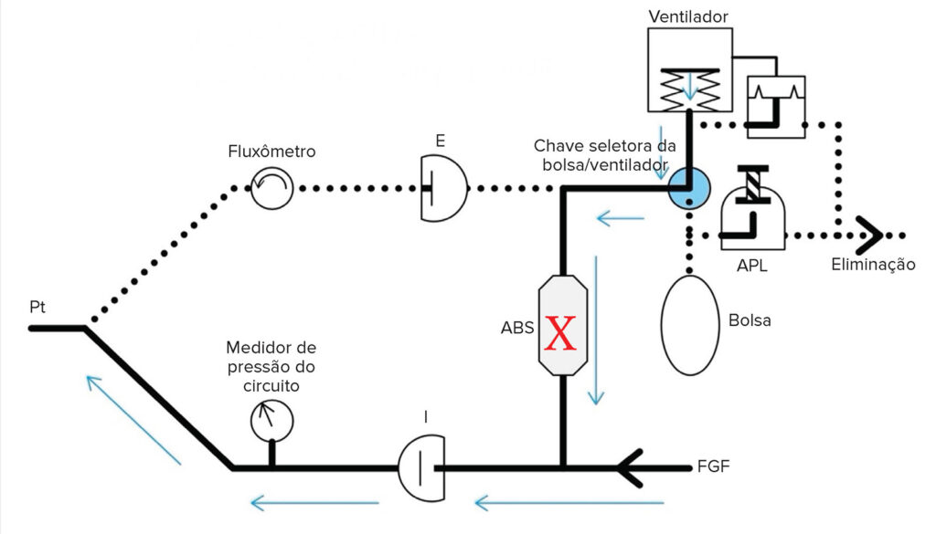 Figura 3: Esquema do circuito de respiração do tipo fole (GE e alguns modelos da Mindray) com o local do vazamento indicado com um X. Tanto a ventilação mecânica quanto a manual são afetadas de forma semelhante se houver um vazamento no recipiente, pois ambas estão no mesmo local do circuito e são selecionadas pelo interruptor da bolsa/ventilador. Em todos os casos, a ventilação com pressão positiva pode ser difícil ou impossível, dependendo do tamanho do vazamento. O vazamento será indicado pelo colapso do fole ou da bolsa do reservatório. (Figura criada pelo Dr. Kuruma.) <br /><br />
ABS = Recipiente absorvente; FGF = Fluxo de gás fresco; APL = Limite de pressão ajustável.